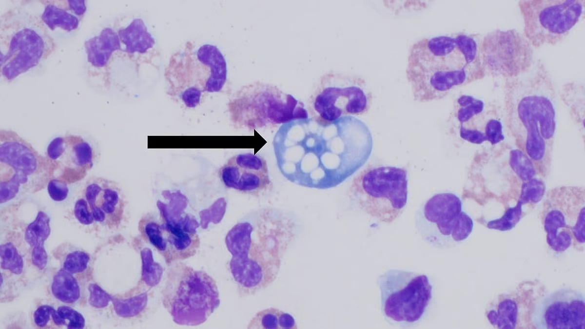 ಮೆದುಳು ತಿನ್ನುವ ಅಮೀಬಾ ಅಥವಾ Amebic Meningo encephalitis (ಕುಶಲವೇ ಕ್ಷೇಮವೇ)